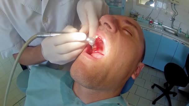 Dentista Trabajo Preparando Los Dientes Del Hombre Adulto Paciente Para — Vídeos de Stock