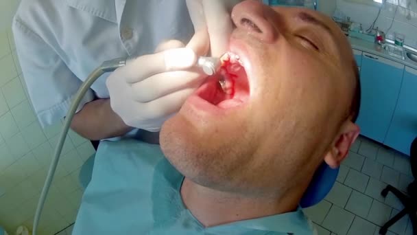 Dentiste Travail Préparant Les Dents Homme Adulte Patient Pour Implant — Video