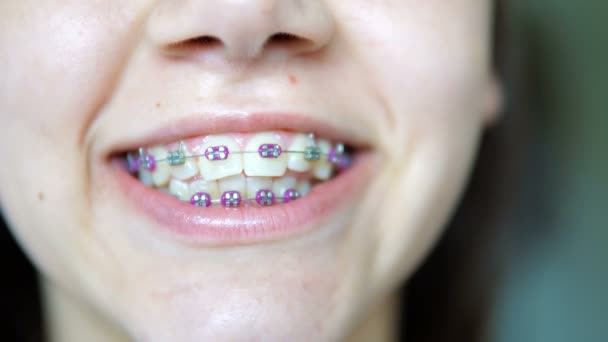Lächelndes Teenager Mädchen Zeigt Ihre Zahnspange — Stockvideo
