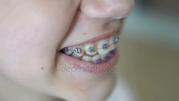 Ortodontik Diş Telleri Gösterilen Gülümseyen Genç Kadın Yakın Çekim — Stok video