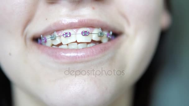 Lächelndes Teenager Mädchen Zeigt Ihre Zahnspange — Stockvideo