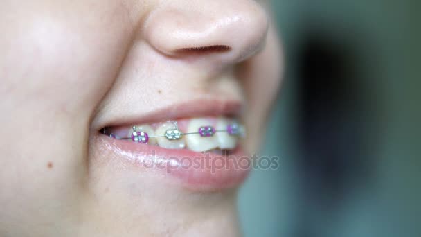 Nahaufnahme einer lächelnden jungen Frau mit Zahnspangen