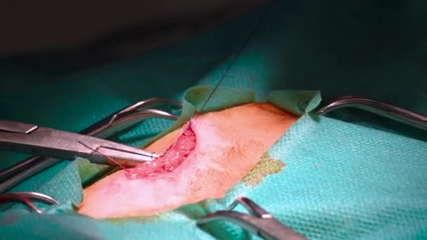 A Surgeon Is Stitching A Wound After an Operation In A Hospital. — Stock Video