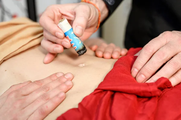 Terapeuta alternativo aplicando moxibustión un método tradicional de medicina china . —  Fotos de Stock