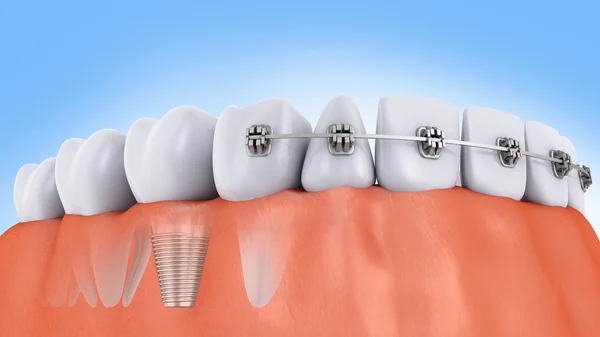 Dentes e implante — Fotografia de Stock
