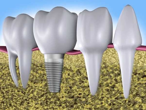 Denti e impianto — Foto Stock