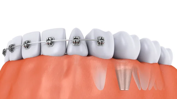 Zęby i implantu — Zdjęcie stockowe