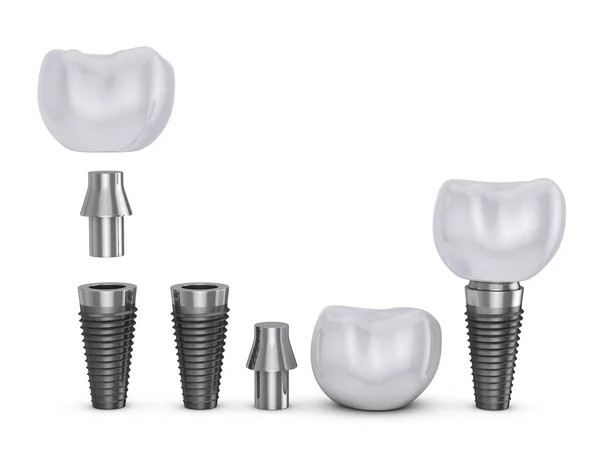 The tooth implant — Stock Photo, Image