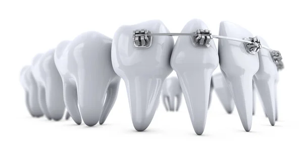 Brackets on the teeth — Stock Photo, Image