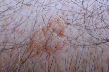 Sample of seborrheic keratosis, common non cancerous skin growth,  people tend to get more of them as they get older clipart