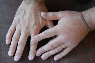 Eşekarısı sokmasından şişmiş bir yumruk, koyu ahşap arka planda sağlıklı bir yumruğa kıyasla, yakın görüş.