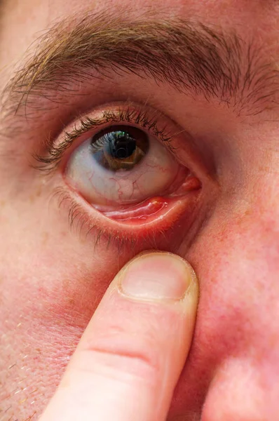 Närbild Makro Man Med Stye Hordeolum Bakteriell Ögoninfektion Inuti Ögonlocket — Stockfoto