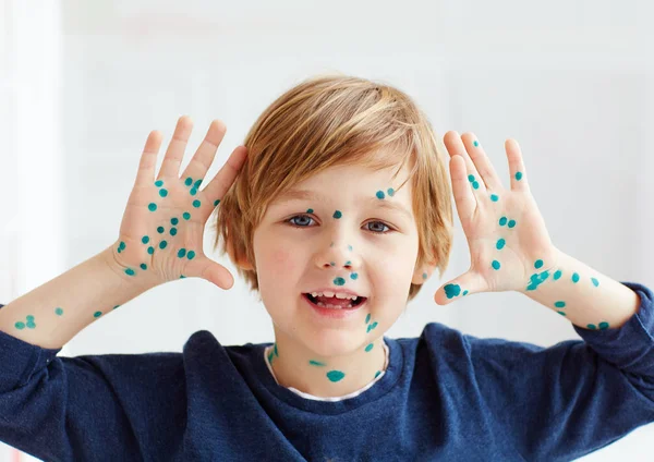 귀여운 어린 소년, 아이 수 두, 화려한 녹색 살 균으로 치료 하는 데 — 스톡 사진