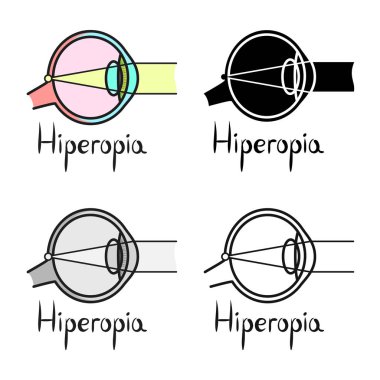 Hiperopi ve göz küresi sembolünün vektör tasarımı. Hiperopya ve göz vektörü illüstrasyonunun web ögesi.
