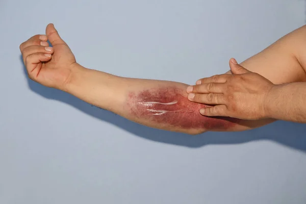 Man smears hematoma on elbow — Stock Photo, Image