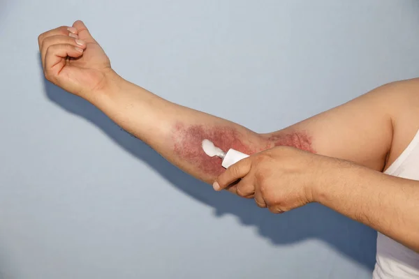 Man smears medicine on hematoma — Stock Photo, Image