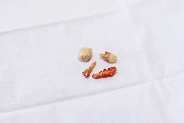 Удаленный зуб и корона сломаны — стоковое фото