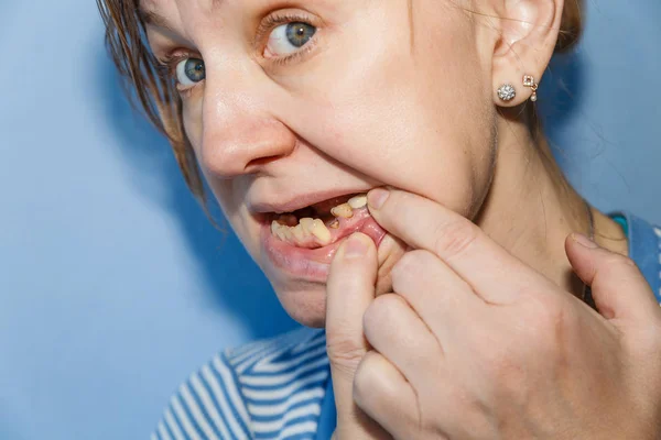 Ženy bez (zlomený zub) — Stock fotografie