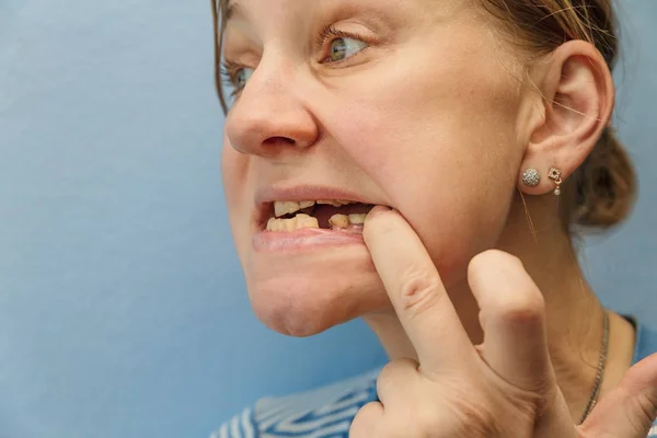Kobieta bez zębów (złamane) — Zdjęcie stockowe