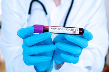 Doktor, Coronavirus 2019-ncov 'un laboratuara hızla yayılmasının pozitif kan testi sonucunu içeren tıbbi eldiven tüpünü getirdi. Coronavirus Covid-19 salgını. Tıp ve salgın konsepti.