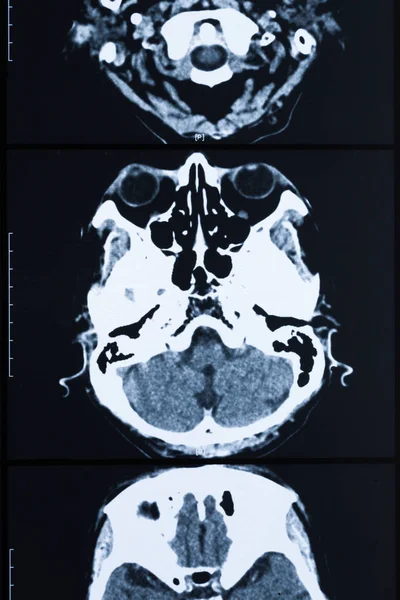 human brain skull bones xray