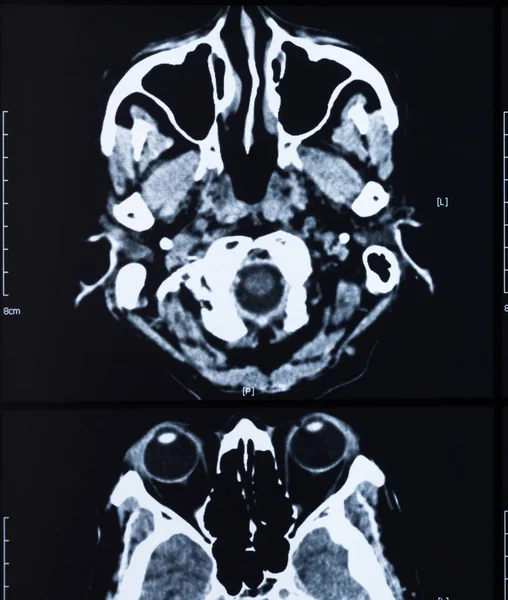 Cerveau humain os du crâne radiographie — Photo