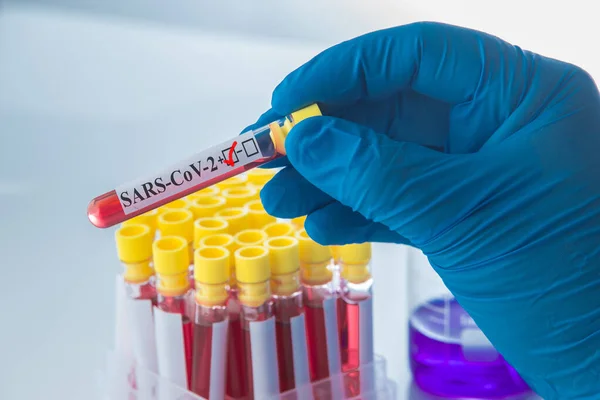 Blood Test Positive Coronavirus Result Sars Cov — Stock Photo, Image