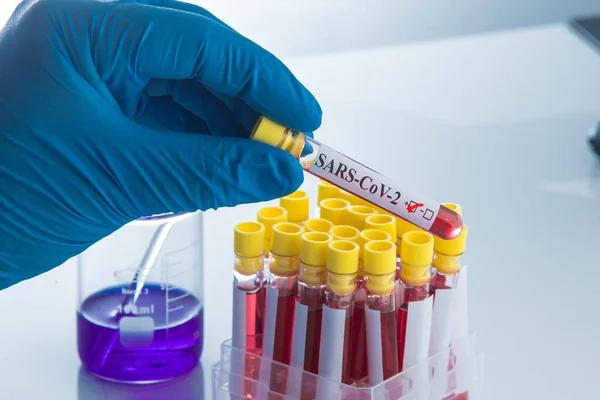 Blood Test Positive Coronavirus Result Sars Cov — Stock Photo, Image