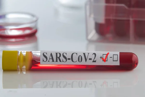 Teste Sangue Resultado Positivo Coronavírus Sars Cov — Fotografia de Stock