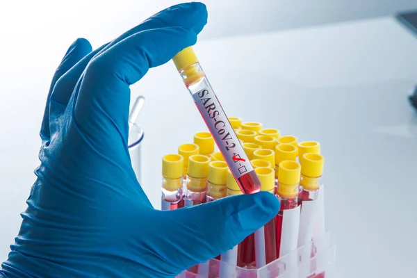 Kan Testi Pozitif Koronavirüs Sonucu Sars Cov — Stok fotoğraf