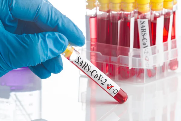 Teste Sangue Resultado Positivo Coronavírus Sars Cov — Fotografia de Stock