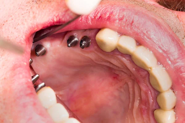 Некоторые зубные имплантаты — стоковое фото
