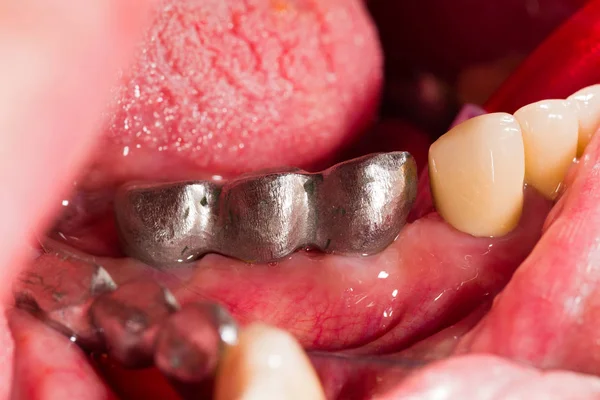 Metalen frame op tandheelkundige implantaten — Stockfoto