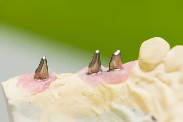Implant dentystyczny — Zdjęcie stockowe