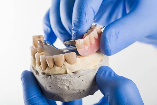 Prótesis esquelética dental - anclaje — Foto de Stock