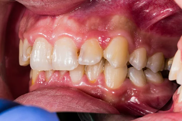 Ejemplos dIdácticos de problemas dentales — Foto de Stock