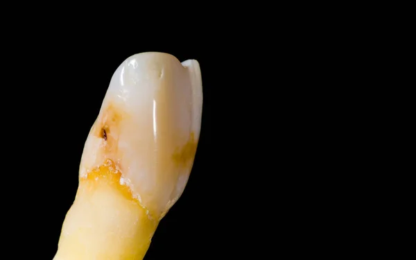 Tooth isolated on black — Stock Photo, Image