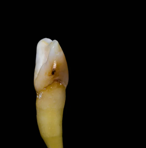 Dente isolado em preto — Fotografia de Stock