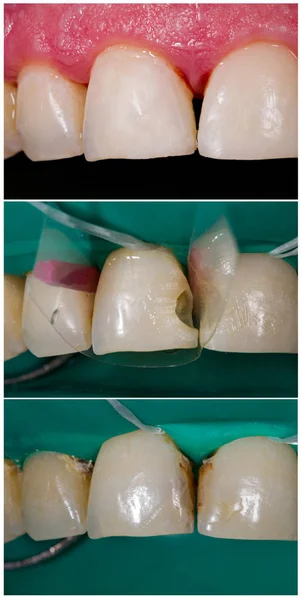 High-end nanohybrid dental filling — Stock Photo, Image