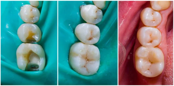 Upper molar and premolar aesthetic filling — Stock Photo, Image