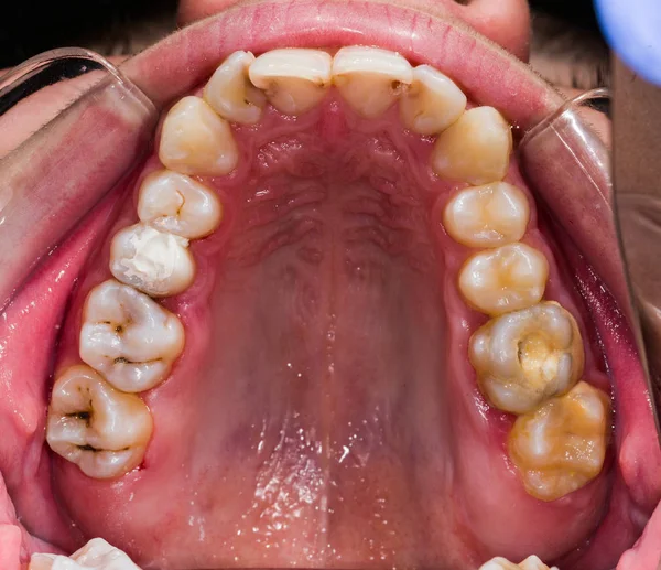 Zerfallende Zähne beim Menschen — Stockfoto