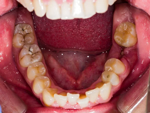 Dientes humanos en descomposición — Foto de Stock