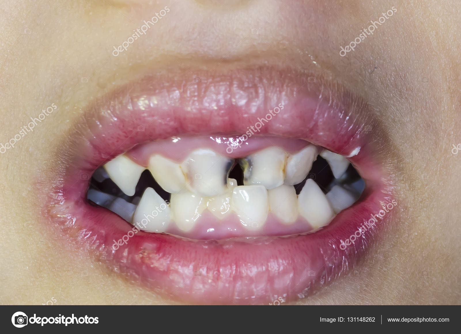 Bambini asiatici sorriso con i denti cariati — Foto di mrfiza