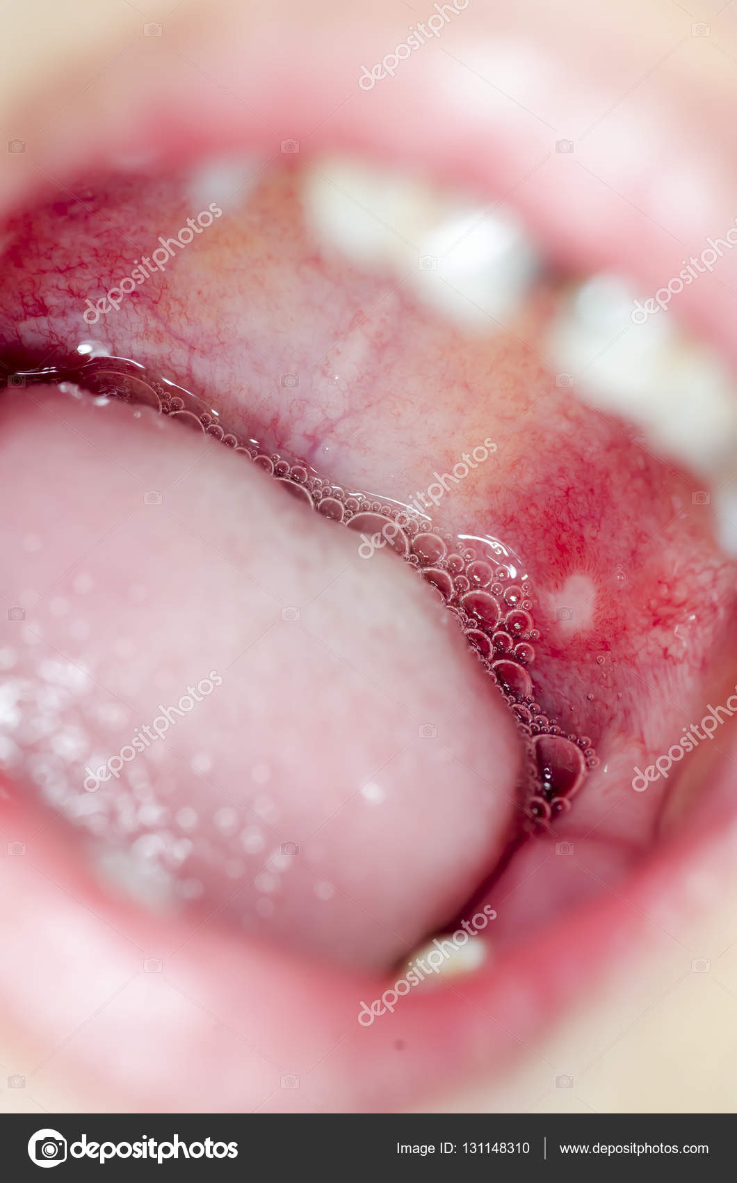bouche infection bouche infection
