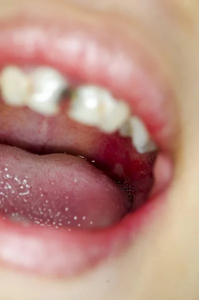 Infection of ulcer inside mouth — Stock Photo, Image
