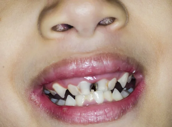 Aziatische kinderen glimlach met vergane tanden — Stockfoto