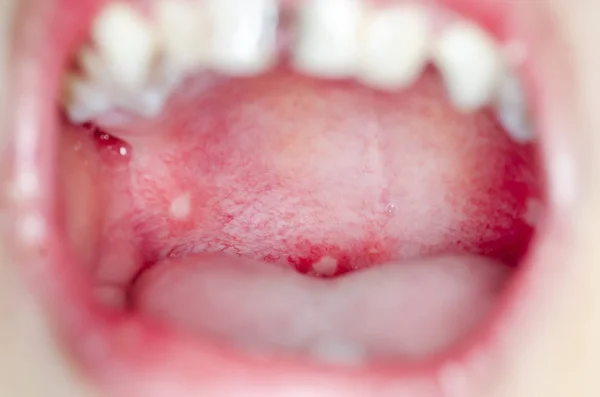 感染的口腔内溃疡 — 图库照片
