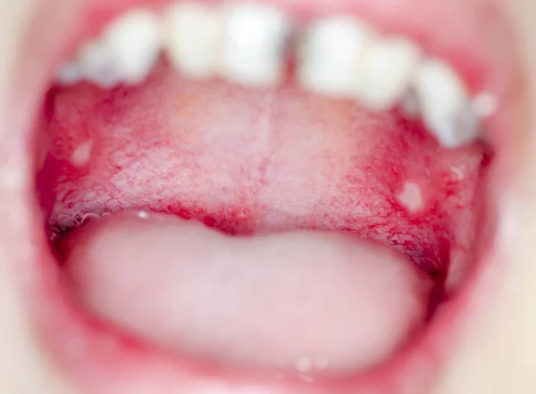 Infection of ulcer inside mouth — Stock Photo, Image