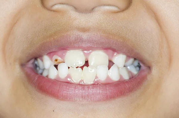 Asiatiques enfants sourire avec des dents cariées — Photo