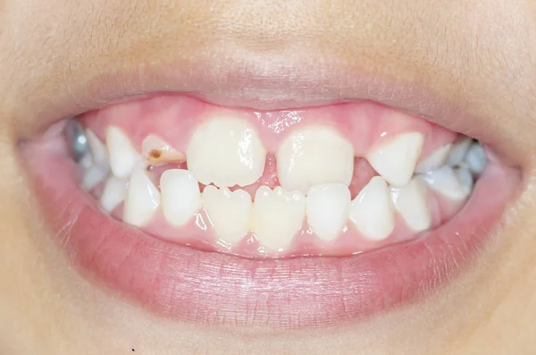 Los niños asiáticos sonríen con dientes deteriorados — Foto de Stock